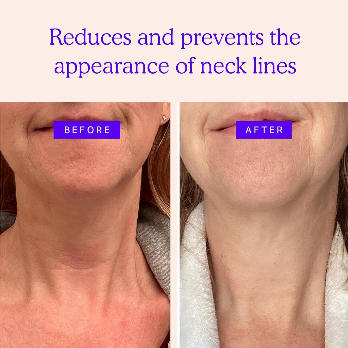 BLUMBODY Neck Wrinkle Patches – Anti-Wrinkle Silicone Patches for Skin Firming, Tightening – Reusable Overnight Pads – Anti-Aging Crepe Erase Pads – Neck, Décolleté (1-Month Supply)